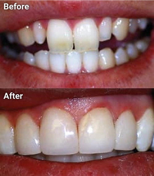 The image shows a before-and-after comparison of teeth whitening, with the left side showing discolored teeth and the right side showing the same teeth after being treated with a whitening procedure.