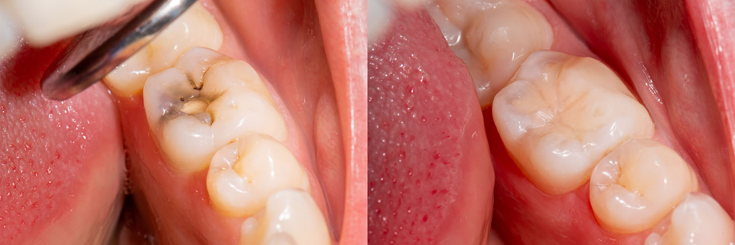The image shows a close-up view of an open mouth with teeth and gums, possibly for dental examination or treatment purposes.